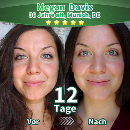 Purelora® Stammzellen-abgeleitetes EGF & Kupferpeptid-Aktivierungsserum (Aktiviert die Hauterneuerung von innen heraus für eine straffere, glattere Haut)（副本）