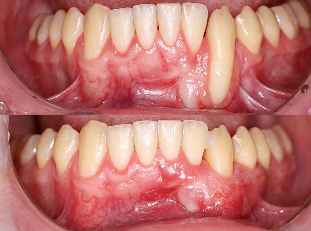 💎 Purelora® GumRevive Parodontal-Reparaturgel