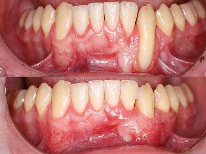 💎 Purelora® GumRevive Parodontal-Reparaturgel