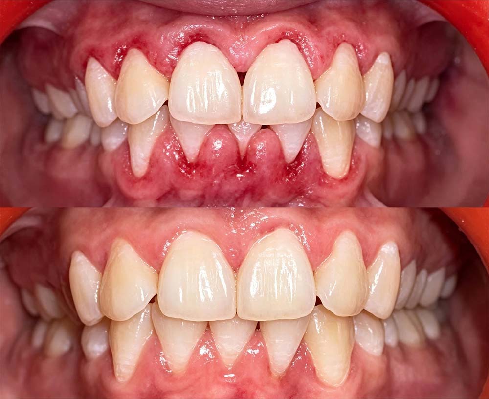💎 Purelora® GumRevive Parodontal-Reparaturgel